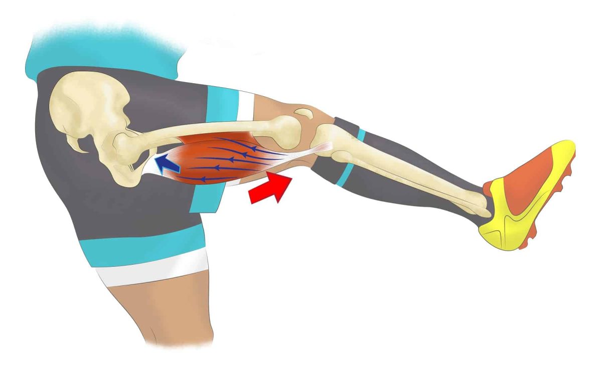 La déchirure musculaire en football